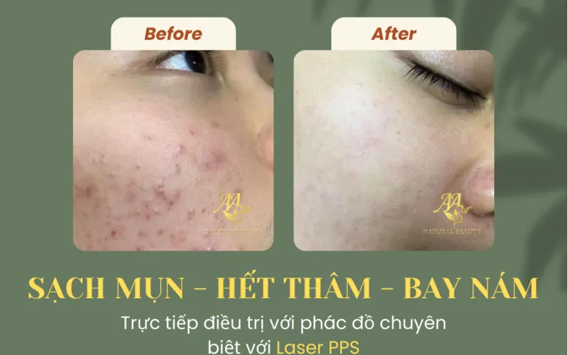 Sản phẩm hyperpigmentation treatment 1_1715225772 — Công Ty Cổ Phần Hoàng Ngọc Thảo — MST 0105117492