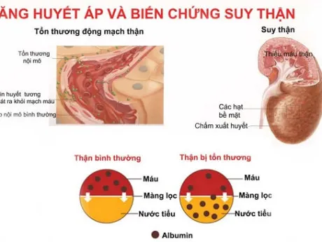 Sản phẩm tang huyet ap va bien chung suy than 4 min 460x345 — Bác Sĩ Tim Mạch — MST 0105840045