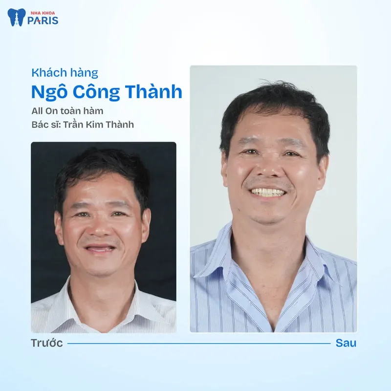 Sản phẩm kh cong thanh.jpg — Nha Khoa Paris — MST 0107473432