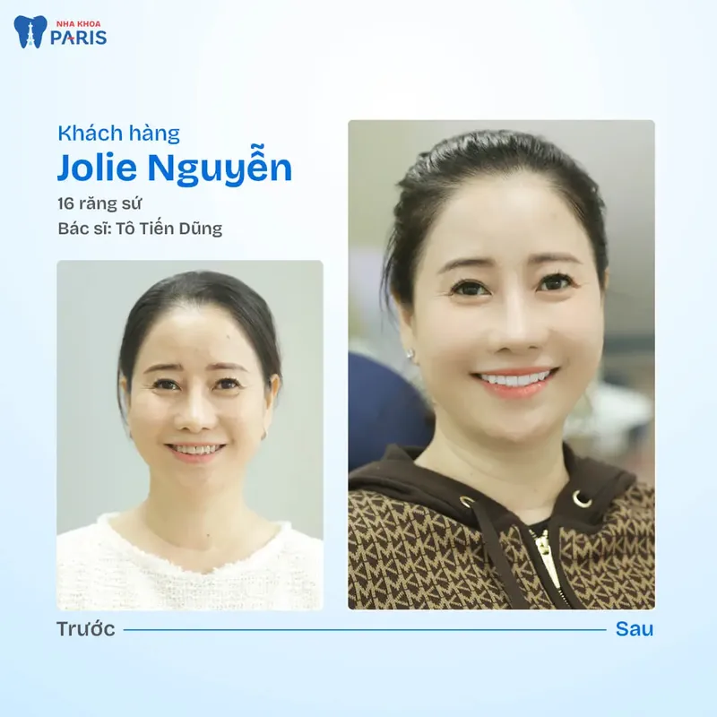 Sản phẩm kh jollie nguyen.jpg — Nha Khoa Paris — MST 0107473432