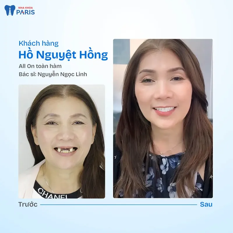 Sản phẩm kh nguyet hong.jpg — Nha Khoa Paris — MST 0107473432