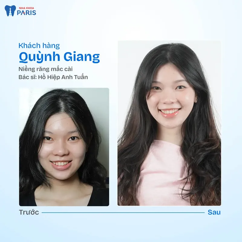 Sản phẩm kh quynh giang.jpg — Nha Khoa Paris — MST 0107473432