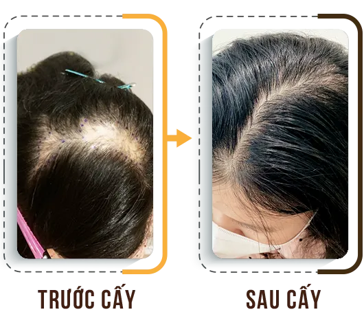 Sản phẩm Cay seo 1 — Phòng Khám Cấy Ghép Tóc Y Học Quốc Tế — MST 0108360583