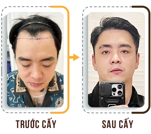 Sản phẩm cay tri hoi 1 — Phòng Khám Cấy Ghép Tóc Y Học Quốc Tế — MST 0108360583