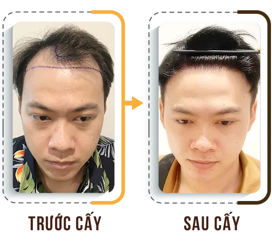 Sản phẩm cay tri hoi 2 — Phòng Khám Cấy Ghép Tóc Y Học Quốc Tế — MST 0108360583
