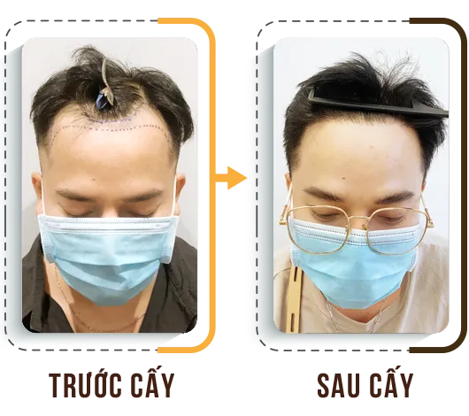 Sản phẩm cay tri hoi 3 — Phòng Khám Cấy Ghép Tóc Y Học Quốc Tế — MST 0108360583