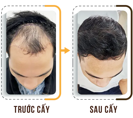 Sản phẩm cay tri hoi 4 — Phòng Khám Cấy Ghép Tóc Y Học Quốc Tế — MST 0108360583