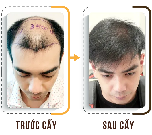 Sản phẩm cay tri hoi 5 — Phòng Khám Cấy Ghép Tóc Y Học Quốc Tế — MST 0108360583