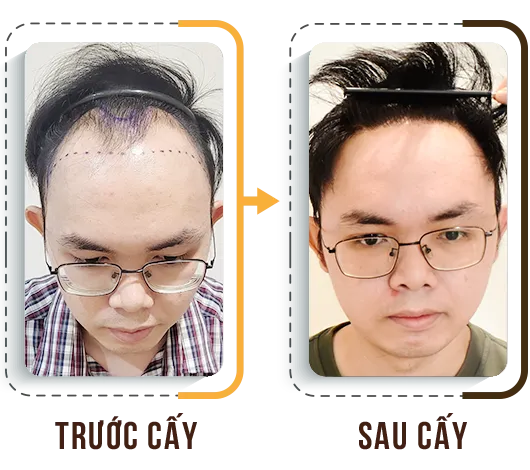 Sản phẩm cay tri hoi 6 — Phòng Khám Cấy Ghép Tóc Y Học Quốc Tế — MST 0108360583
