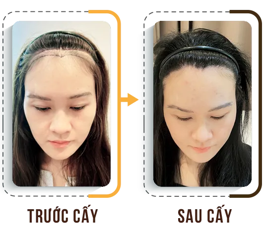 Sản phẩm hdct1 — Phòng Khám Cấy Ghép Tóc Y Học Quốc Tế — MST 0108360583