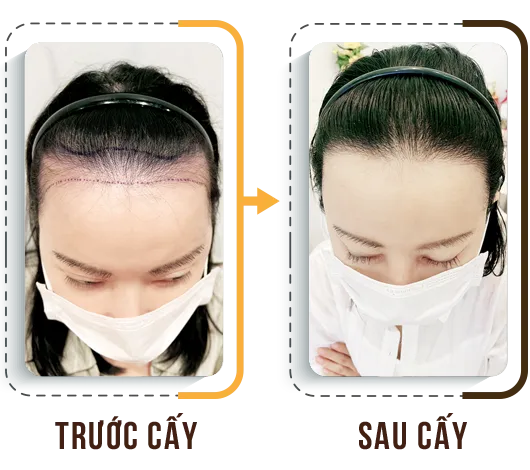 Sản phẩm hdct2 — Phòng Khám Cấy Ghép Tóc Y Học Quốc Tế — MST 0108360583