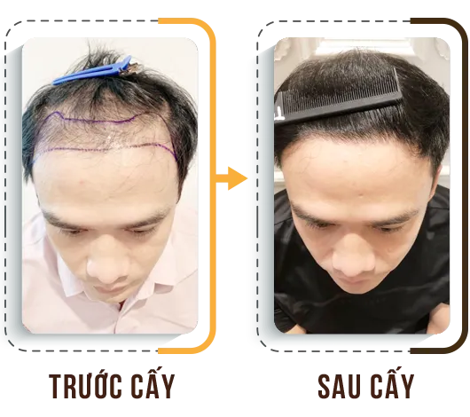 Sản phẩm hdct3 — Phòng Khám Cấy Ghép Tóc Y Học Quốc Tế — MST 0108360583
