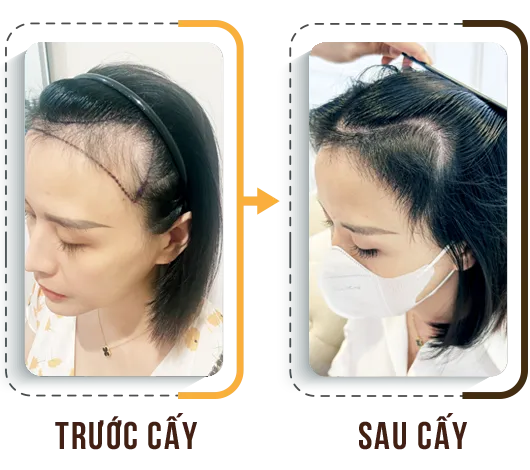 Sản phẩm hdct4 — Phòng Khám Cấy Ghép Tóc Y Học Quốc Tế — MST 0108360583