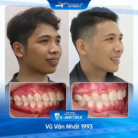 Sản phẩm Hinh anh khach hang nieng rang nha khoa lac viet intech 1 1 — Nha Khoa Lạc Việt Intech — MST 0108432340