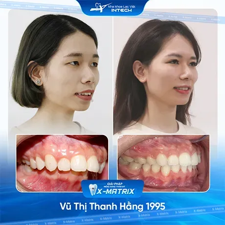 Sản phẩm Hinh anh khach hang nieng rang nha khoa lac viet intech 2 1 — Nha Khoa Lạc Việt Intech — MST 0108432340