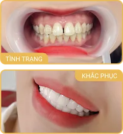Sản phẩm rangho — Phòng Khám Nha Khoa Hải Đăng — MST 0108780644
