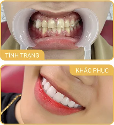 Sản phẩm rangkhapkhenh — Phòng Khám Nha Khoa Hải Đăng — MST 0108780644