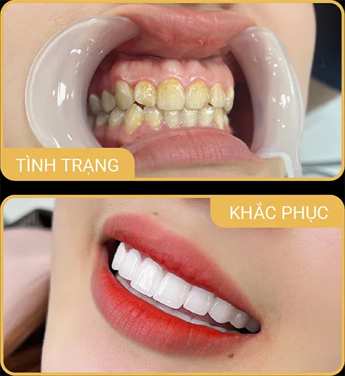 Sản phẩm rangovang2 — Phòng Khám Nha Khoa Hải Đăng — MST 0108780644