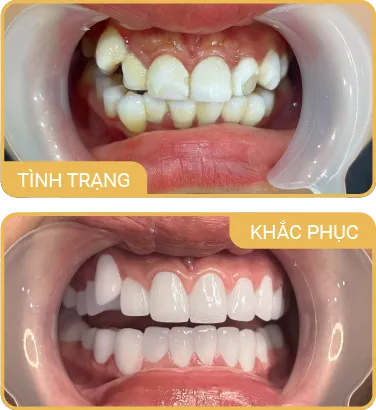Sản phẩm rangphunano 1 — Phòng Khám Nha Khoa Hải Đăng — MST 0108780644