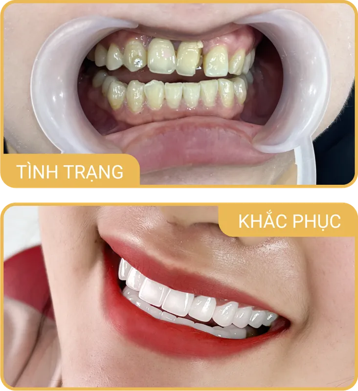 Sản phẩm rangsutme — Phòng Khám Nha Khoa Hải Đăng — MST 0108780644