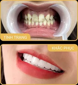 Sản phẩm rangthua2 — Phòng Khám Nha Khoa Hải Đăng — MST 0108780644