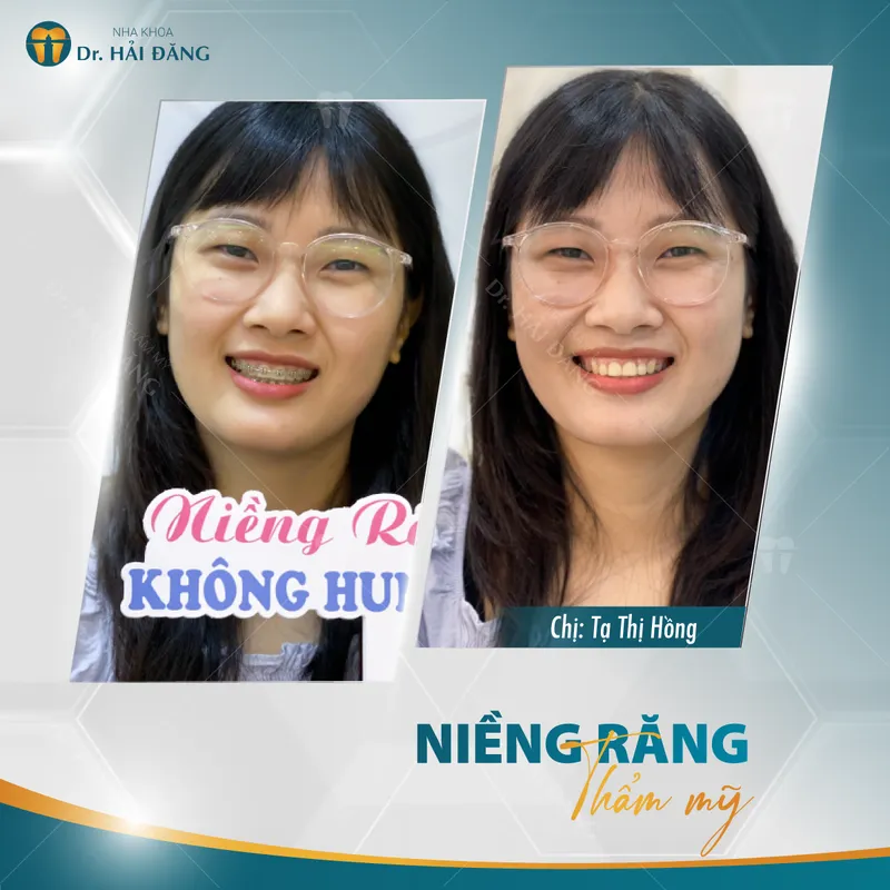Sản phẩm C hong nieng rang — Phòng Khám Nha Khoa Hải Đăng — MST 0108780644