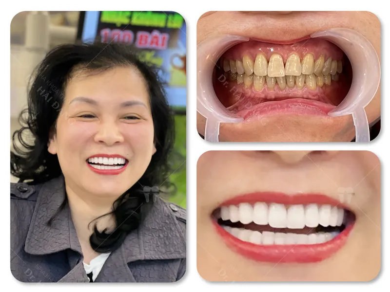 Sản phẩm Chi Hoa — Phòng Khám Nha Khoa Hải Đăng — MST 0108780644