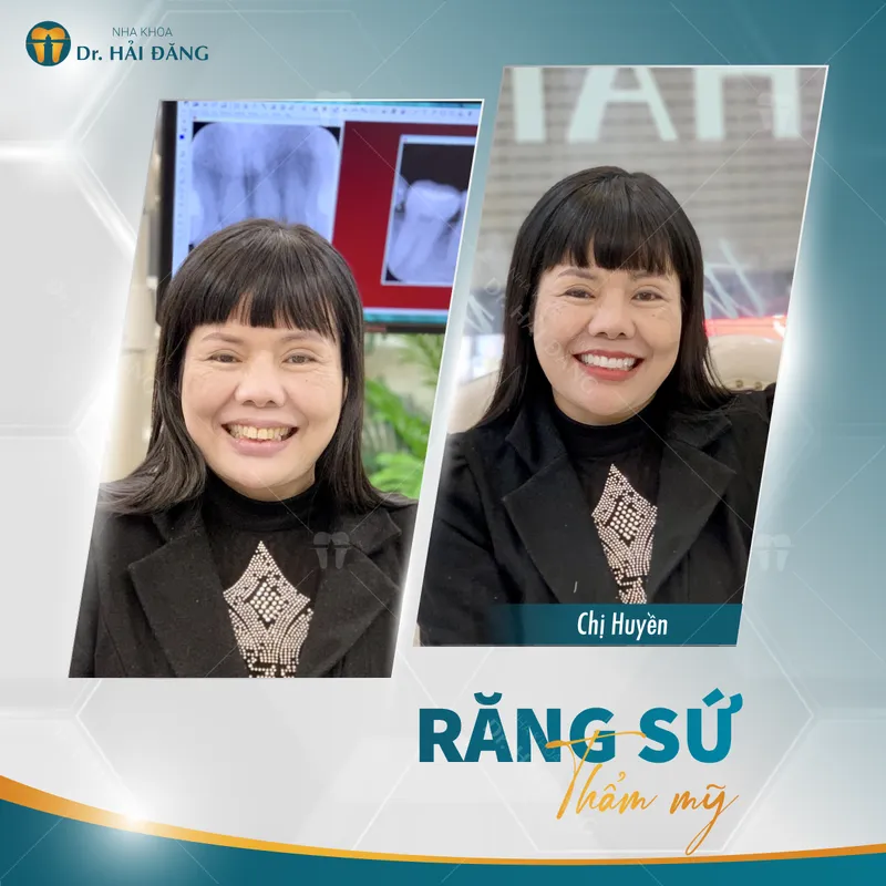 Sản phẩm c huyen — Phòng Khám Nha Khoa Hải Đăng — MST 0108780644