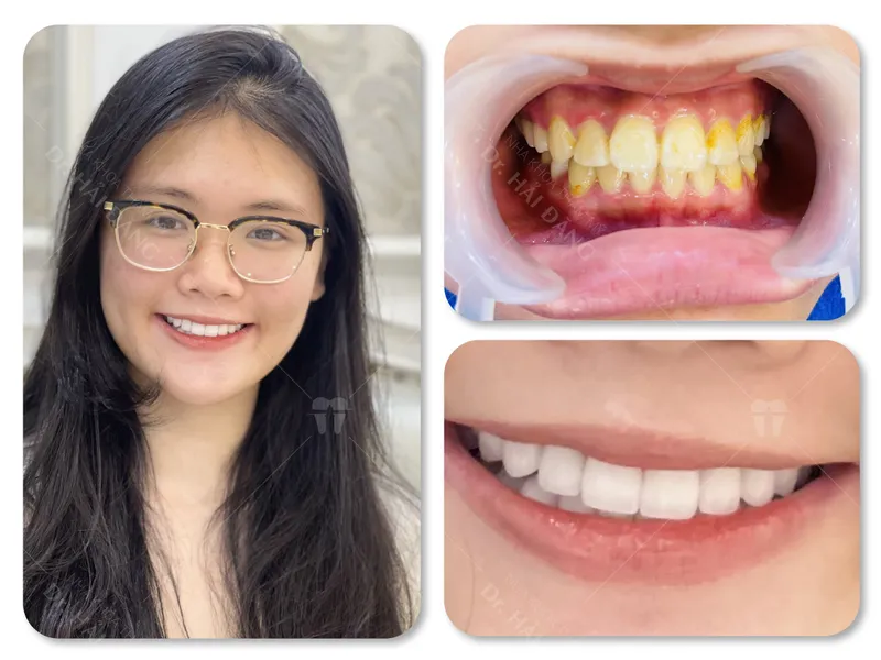 Sản phẩm ta hong duyen — Phòng Khám Nha Khoa Hải Đăng — MST 0108780644