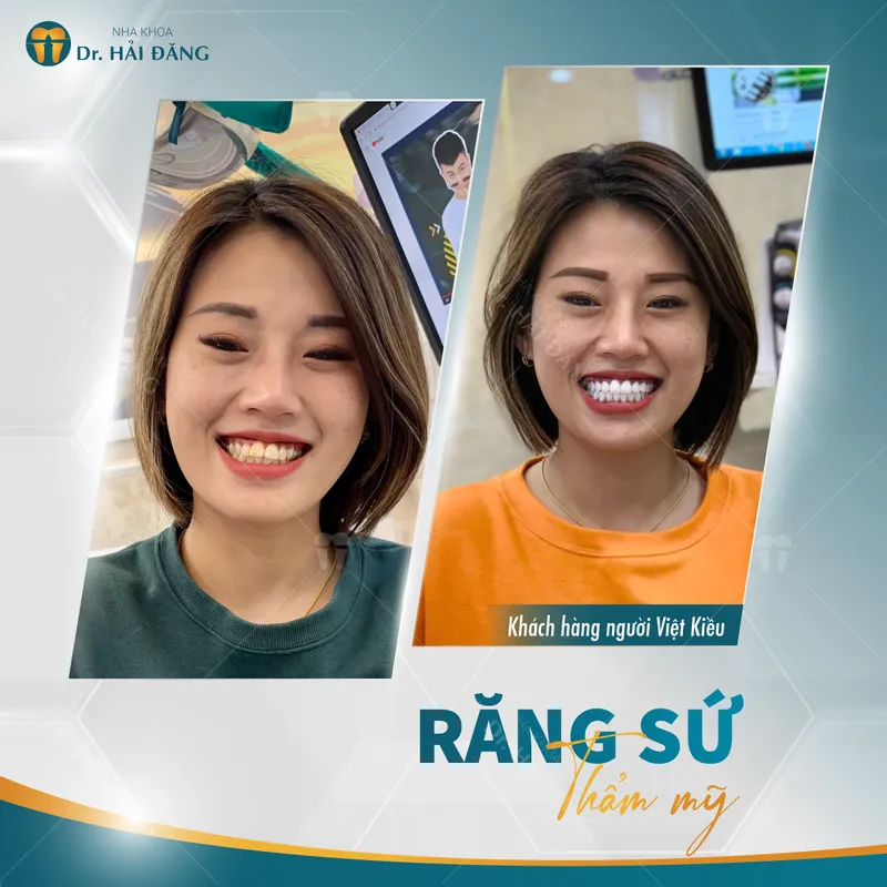 Sản phẩm viet kieu — Phòng Khám Nha Khoa Hải Đăng — MST 0108780644