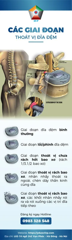 Sản phẩm Cac giai doan thoat vi 01 1 — Công Ty Cổ Phần Tập Đoàn Y Dược 5T-P — MST 0109429559