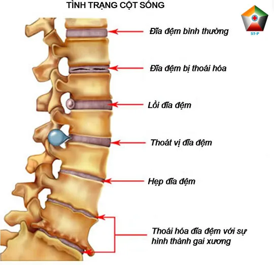 Sản phẩm thoat vi dia dem — Công Ty Cổ Phần Tập Đoàn Y Dược 5T-P — MST 0109429559