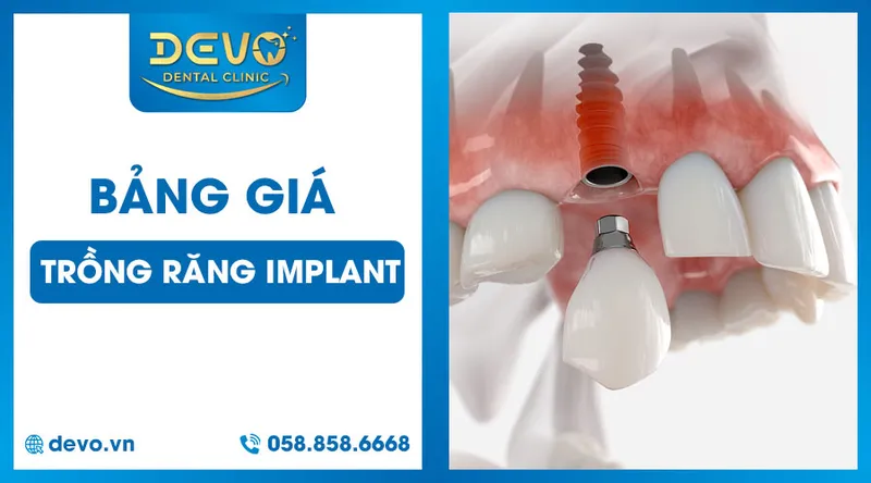 Sản phẩm bang gia trong implant hien nay — Công Ty CP Tập Đoàn DEVO — MST 0110171826