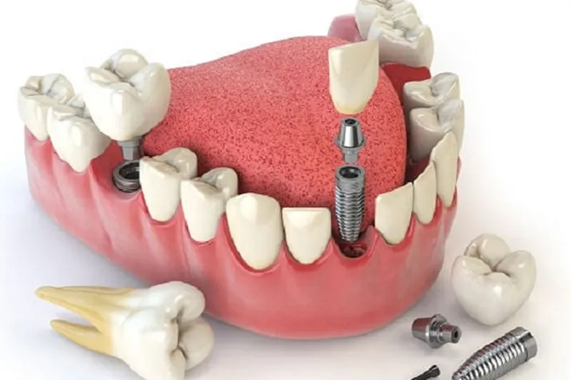 Sản phẩm implant rang khenh — Công Ty CP Tập Đoàn DEVO — MST 0110171826