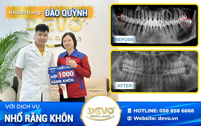 Sản phẩm dao quynh — Công Ty CP Tập Đoàn DEVO — MST 0110171826