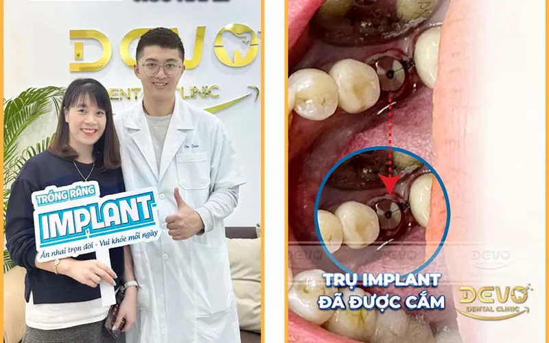 Sản phẩm implant da cam khach hang — Công Ty CP Tập Đoàn DEVO — MST 0110171826