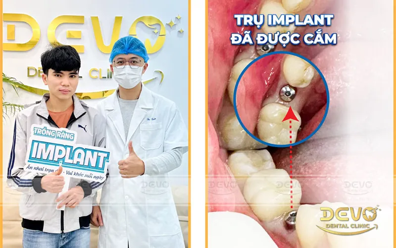 Sản phẩm implant khach hang da trong xong  — Công Ty CP Tập Đoàn DEVO — MST 0110171826