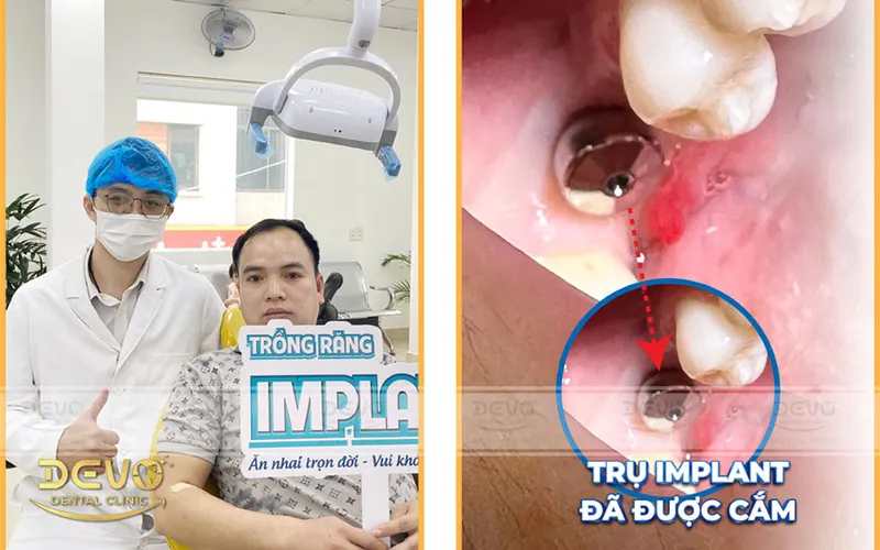 Sản phẩm implant khach hang — Công Ty CP Tập Đoàn DEVO — MST 0110171826