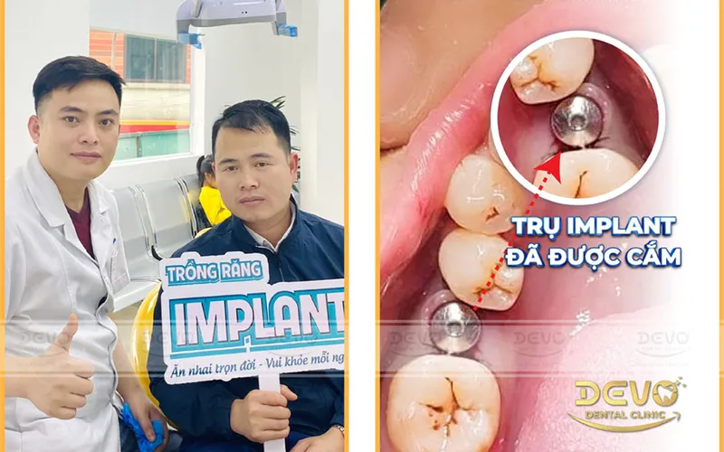 Sản phẩm khach implant cam — Công Ty CP Tập Đoàn DEVO — MST 0110171826
