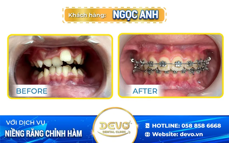 Sản phẩm ngoc anh nieng rang — Công Ty CP Tập Đoàn DEVO — MST 0110171826