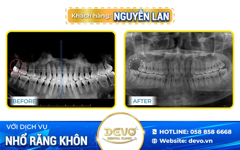 Sản phẩm nguyen lan rang khon — Công Ty CP Tập Đoàn DEVO — MST 0110171826