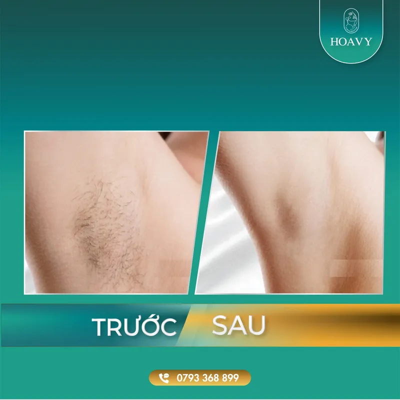 Sản phẩm thammyhoavy.vn dich vu ttriet long vinh vien tre hoa lan da triet long hai phong triet long quang ninh 3 scaled — Công Ty TNHH Thương Mại Dịch Vụ HOAVY — MST 0201703764