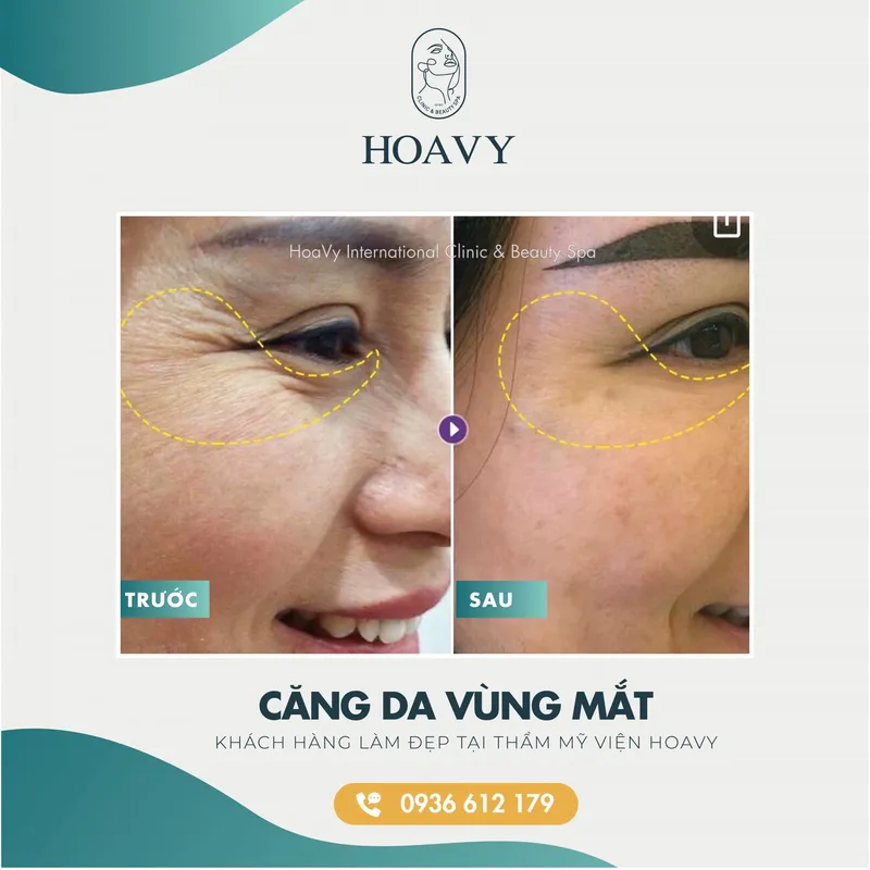 Sản phẩm thammyhoavy.vn hinh anh khach hang lam dep tai hoa vy hai phong quang ninh cang da vung mat scaled — Công Ty TNHH Thương Mại Dịch Vụ HOAVY — MST 0201703764