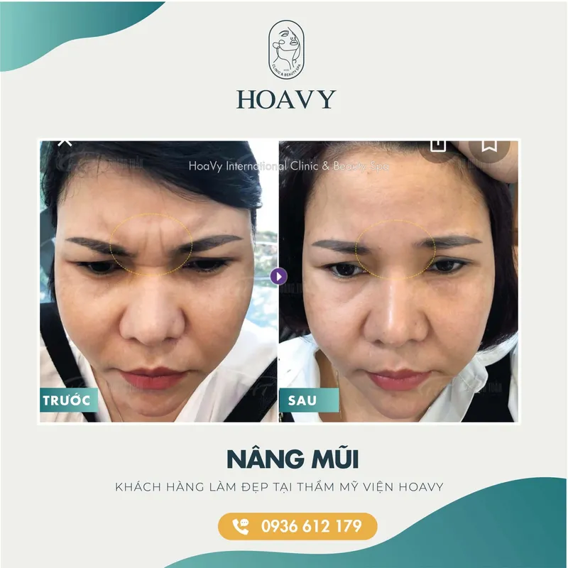 Sản phẩm thammyhoavy.vn hinh anh khach hang lam dep tai hoa vy hai phong quang ninh nang mui scaled — Công Ty TNHH Thương Mại Dịch Vụ HOAVY — MST 0201703764