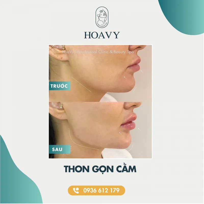 Sản phẩm thammyhoavy.vn hinh anh khach hang lam dep tai hoa vy hai phong quang ninh thon gon cam scaled — Công Ty TNHH Thương Mại Dịch Vụ HOAVY — MST 0201703764