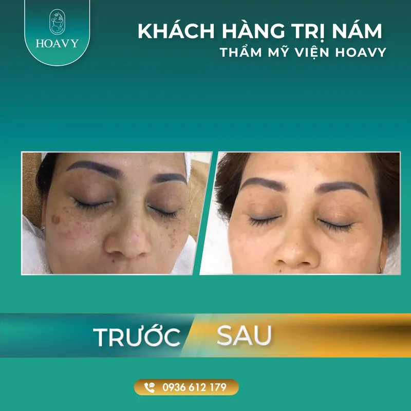 Sản phẩm thammyhoavy.vn hinh anh khach hang lam dep tai hoa vy hai phong quang ninh tri nam scaled — Công Ty TNHH Thương Mại Dịch Vụ HOAVY — MST 0201703764