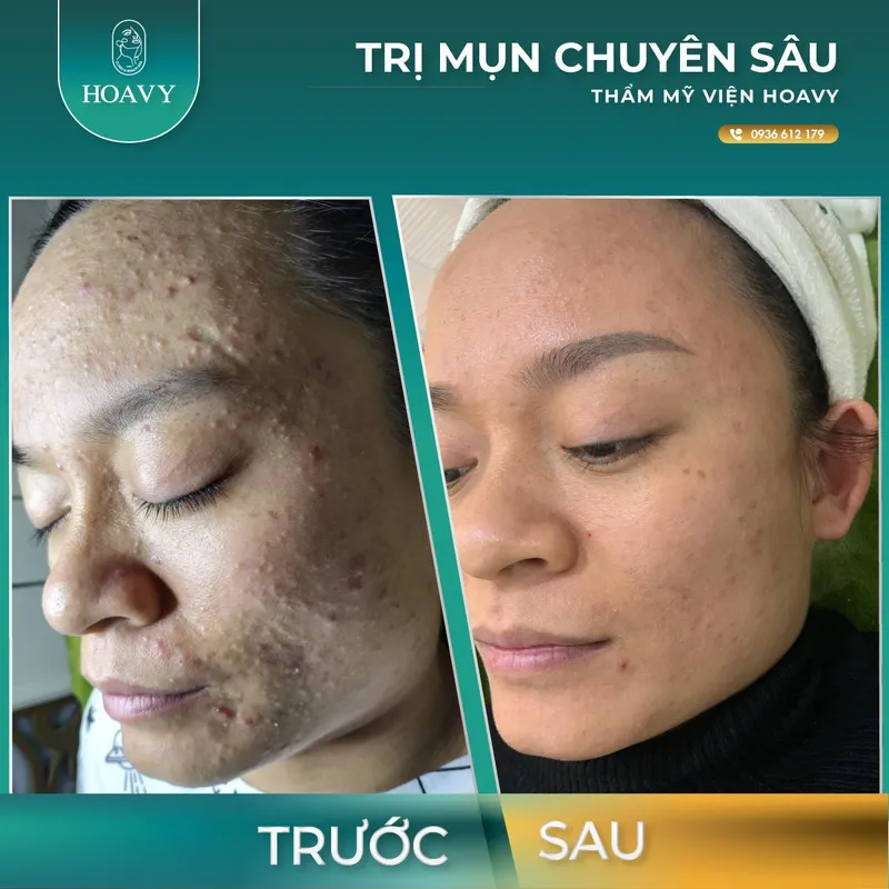 Sản phẩm thammyhoavy.vn tri mun tai hai phong tri mun tai quang ninh tri mun tan goc hieu qua hoavy spa — Công Ty TNHH Thương Mại Dịch Vụ HOAVY — MST 0201703764