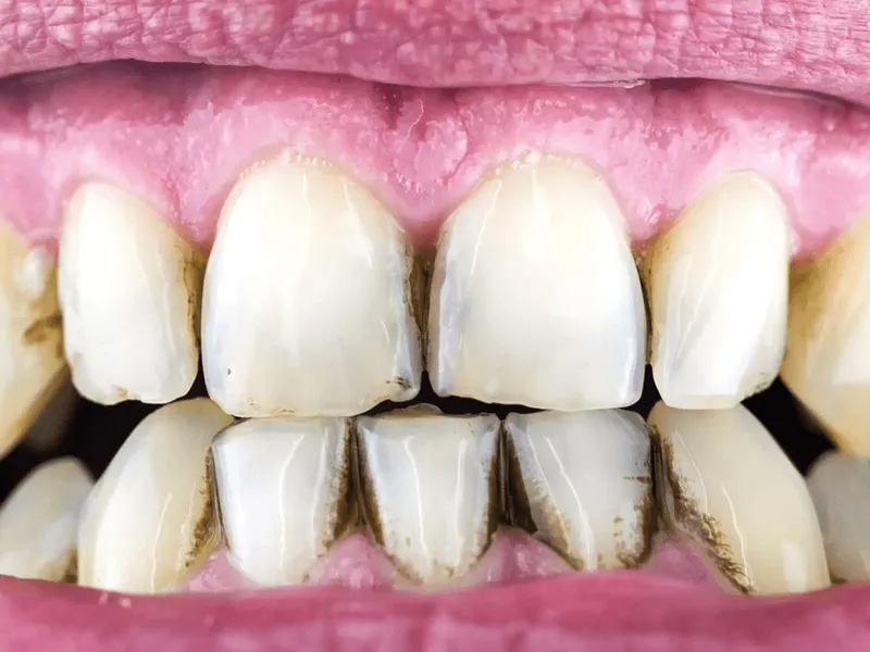 Sản phẩm black tartar on teeth — COLGATE-PALMOLIVE - Công Ty TNHH COLGATE-PALMOLIVE (Việt Nam) — MST 0300546015