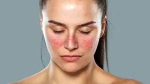 Sản phẩm lupus 300x169 — Công Ty TNHH Bệnh Viện Đức Khang — MST 0302607746