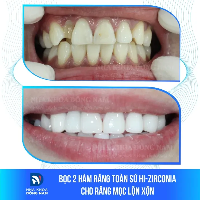 Sản phẩm boc 2 ham rang toan su hi zirconia cho rang moc lon xon — Nha Khoa Đông Nam — MST 0304132304